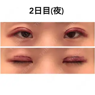 1日目の経過画像（1枚目）