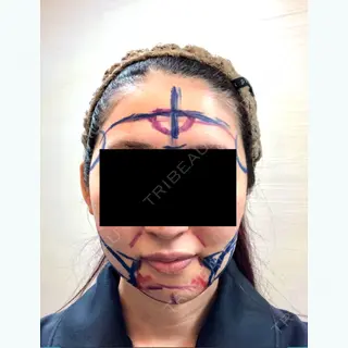 0日目の経過画像（1枚目）