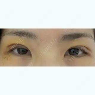 5日目の経過画像（1枚目）