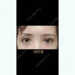13日目の経過画像（1枚目）