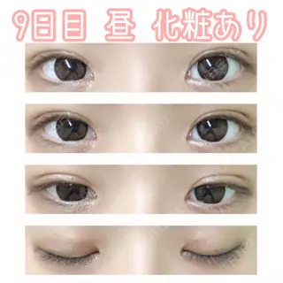 9日目の経過画像（1枚目）