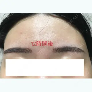 0日目の経過画像（2枚目）