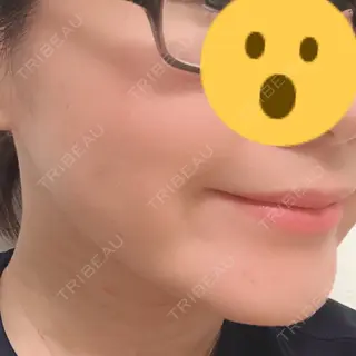 30日目の経過画像（2枚目）