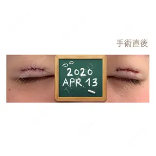 0日目の経過画像（2枚目）