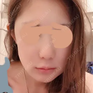 6日目の経過画像（1枚目）