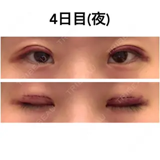 3日目の経過画像（1枚目）