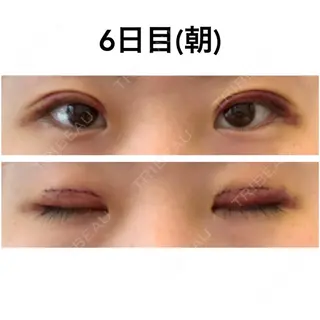 5日目の経過画像（1枚目）