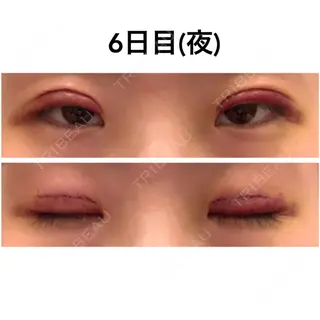 5日目の経過画像（1枚目）