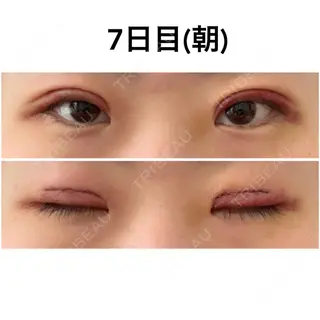 6日目の経過画像（1枚目）
