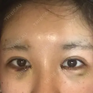3日目の経過画像（1枚目）