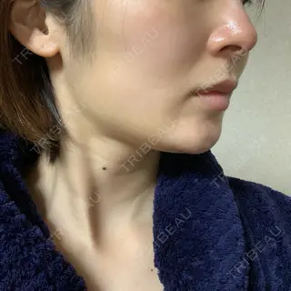 10日目の経過画像（2枚目）