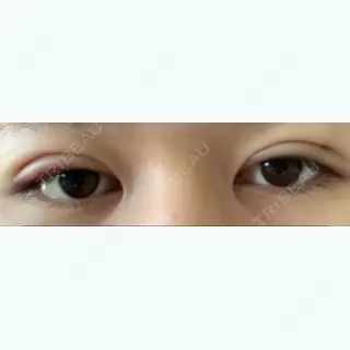 1日目の経過画像（1枚目）