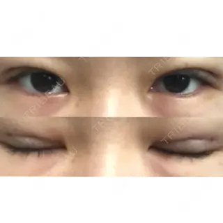 1日目の経過画像（1枚目）
