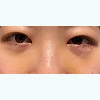 4日目の経過画像（1枚目）