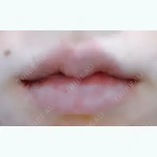 0日目の経過画像（1枚目）