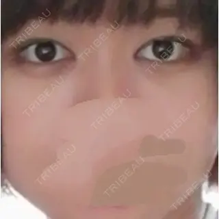 10日目の経過画像（2枚目）