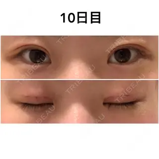 9日目の経過画像（1枚目）