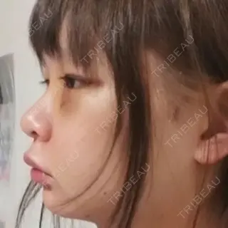 3日目の経過画像（2枚目）