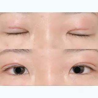 1日目の経過画像（2枚目）