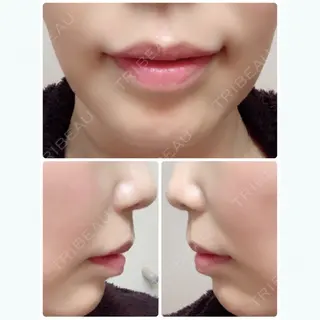 0日目の経過画像（2枚目）