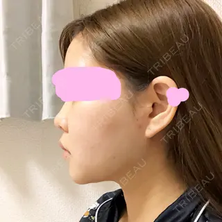 24日目の経過画像（2枚目）