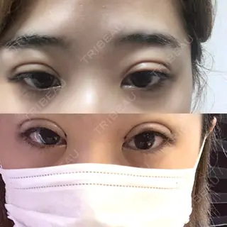8日目の経過画像（2枚目）