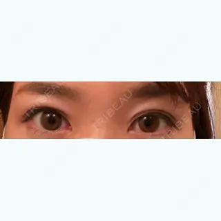 26日目の経過画像（1枚目）