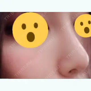 78日目の経過画像（2枚目）