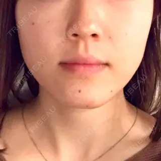 1日目の経過画像（1枚目）