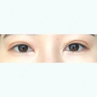 60日目の経過画像（1枚目）