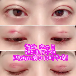 1日目の経過画像（1枚目）