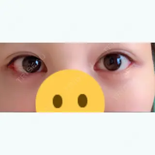 11日目の経過画像（2枚目）