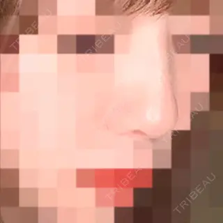 90日目の経過画像（1枚目）