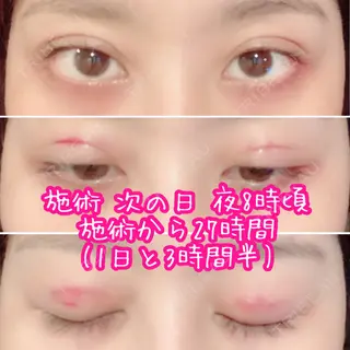 1日目の経過画像（1枚目）