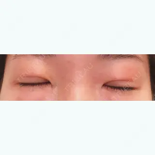 4日目の経過画像（1枚目）