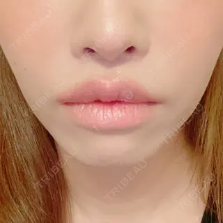 75日目の経過画像（1枚目）