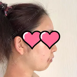 10日目の経過画像（2枚目）