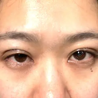 0日目の経過画像（1枚目）