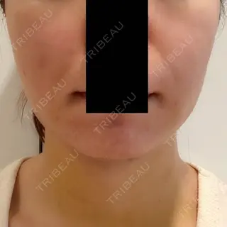 4日目の経過画像（1枚目）