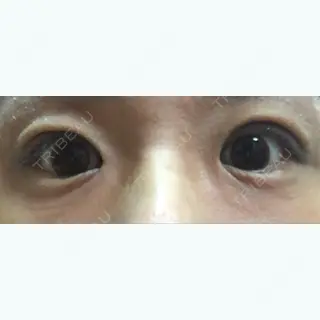 6日目の経過画像（1枚目）