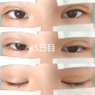 3日目の経過画像（1枚目）