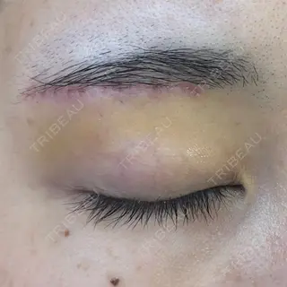 6日目の経過画像（2枚目）