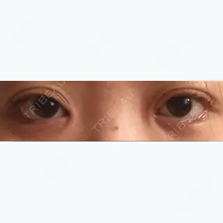 15日目の経過画像（1枚目）