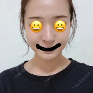 165日目の経過画像（1枚目）