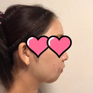 11日目の経過画像（2枚目）