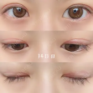 34日目の経過画像（1枚目）