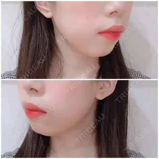 4日目の経過画像（2枚目）