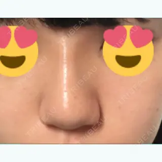 4日目の経過画像（2枚目）