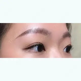 90日目の経過画像（3枚目）