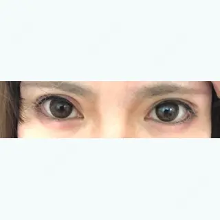 4日目の経過画像（1枚目）